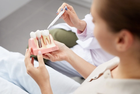 Dental implants